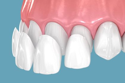 A Practical Guide to Composite Veneers for Working Adults