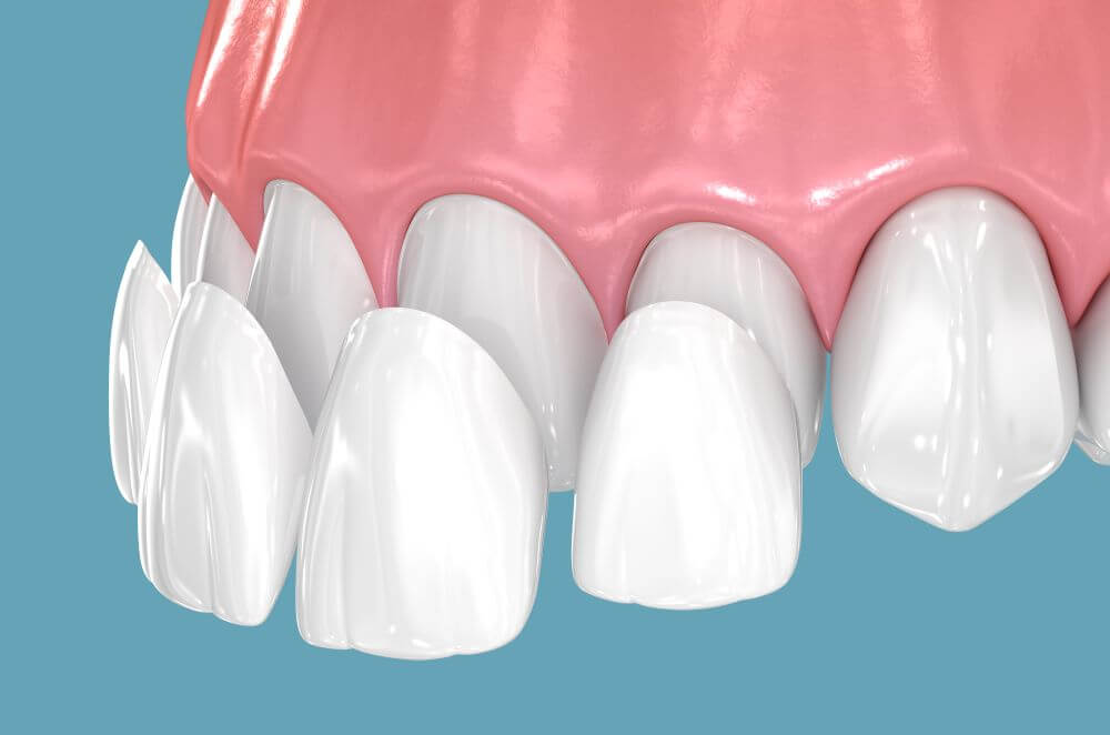 A Practical Guide to Composite Veneers for Working Adults